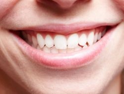Membersihkan Karang Gigi dengan 9 Bahan Alami, Solusi Praktis untuk Kesehatan Mulut